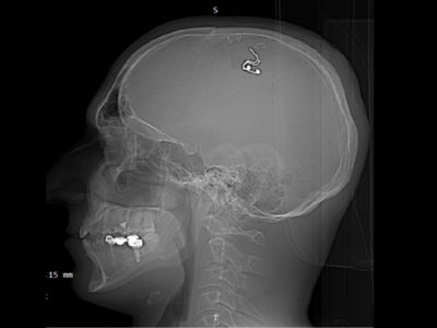 Ученый из Новосибирска просверлил себе череп хозяйственной дрелью и снял это на видео