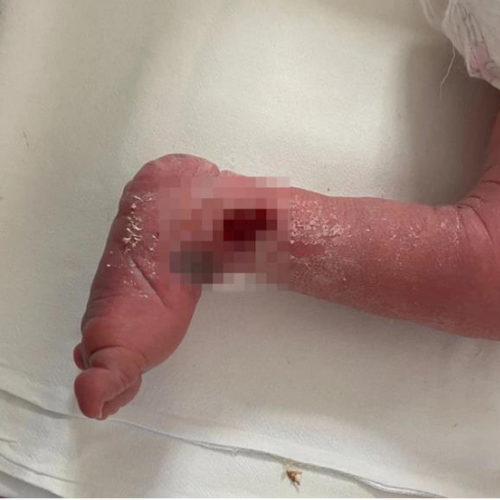 В Новосибирском роддоме новорожденному малышу сломали ногу