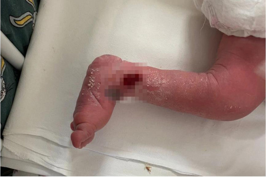 В Новосибирском роддоме новорожденному малышу сломали ногу