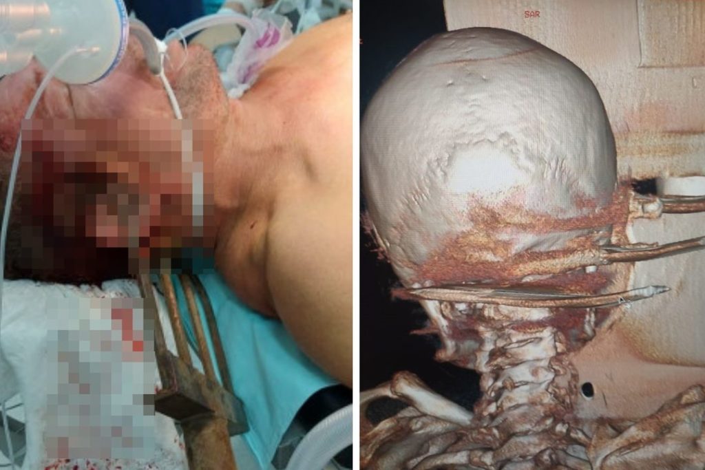 «Фантастический счастливчик»: врачи рассказали о спасении новосибирца с вилами в голове