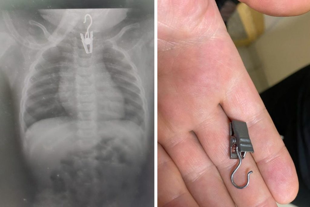 «Он задыхался и синел»: младенца, проглотившего прищепку, спасли врачи в Новосибирске