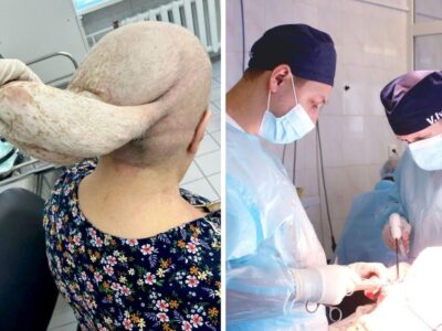 Опухоль-косынку весом 7 кг удалили врачи 70-летней сибирячке