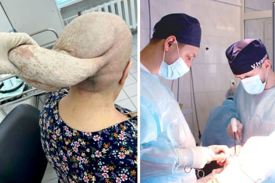 Опухоль-косынку весом 7 кг удалили врачи 70-летней сибирячке
