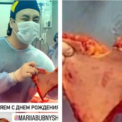 Хирург из Новосибирска, вырезающий поделки из человеческой кожи, попал под статью