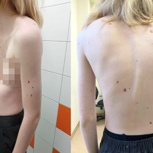 Врачи спасли девушку с деформацией грудины и пороком сердца в Новосибирске