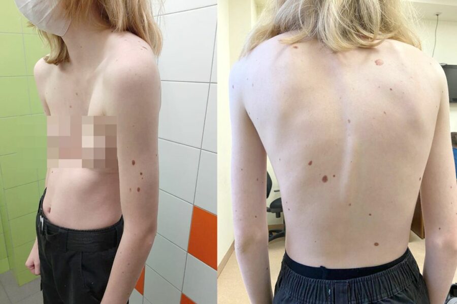 Врачи спасли девушку с деформацией грудины и пороком сердца в Новосибирске