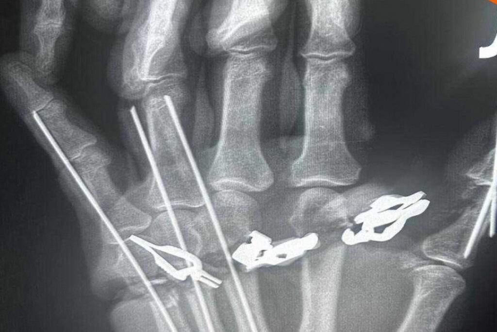 Хирурги Новосибирска успешно восстановили отрезанную кисть мужчине