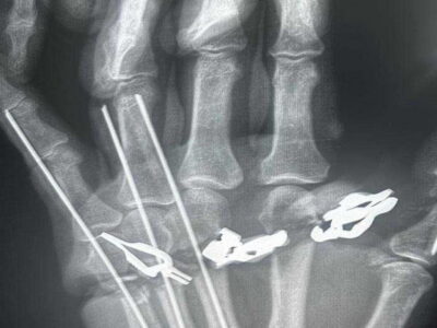 Хирурги Новосибирска успешно восстановили отрезанную кисть мужчине